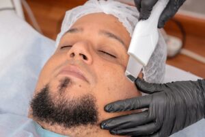 what is chemical peel treatment for hyperpigmentation